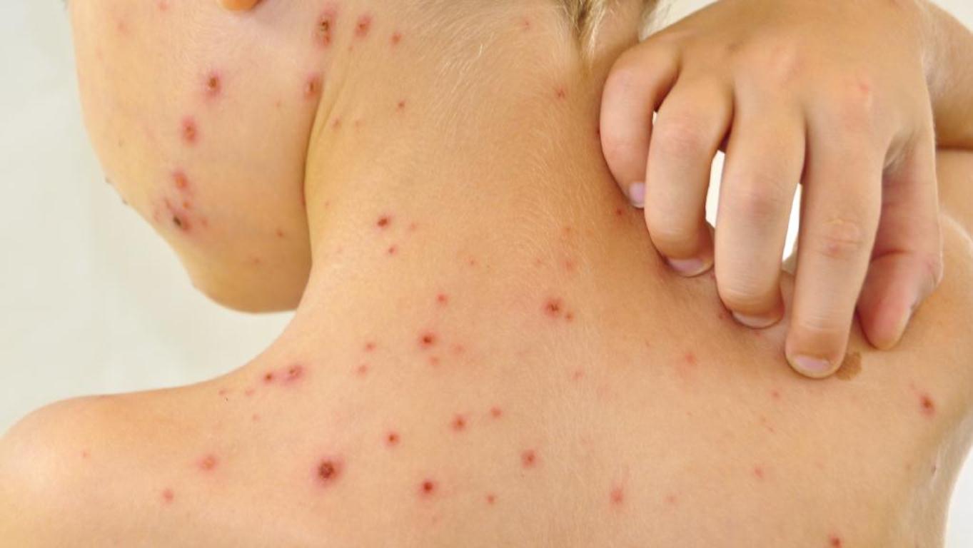 تحذيرات من تفشي مرض جدري الماء بين الأطفال بقطاع غزة