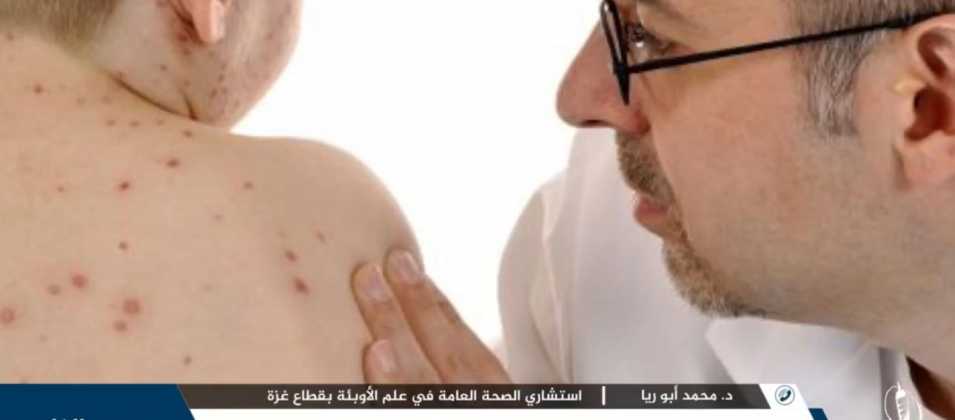 احتمالية وصول فيروس جدري القرود إلى قطاع غزة واردة جدا